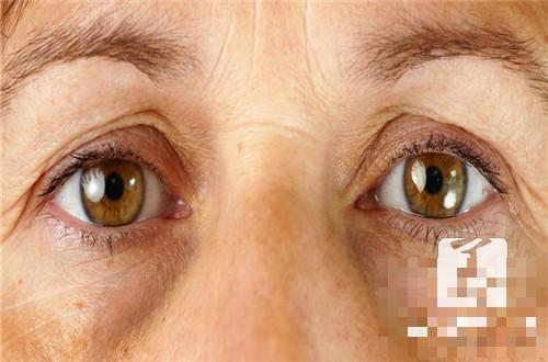 眼角分泌物多的原因有哪些？