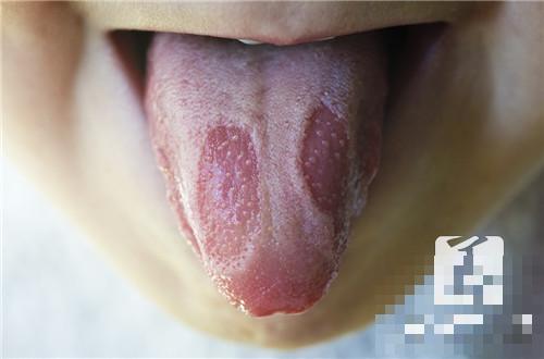 舌苔厚腻有齿痕