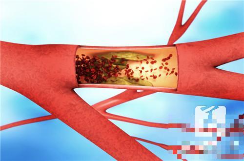 治疗血管炎的方法有哪些？