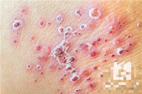 皮肤病白色糠疹怎么治疗？