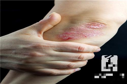 结缔组织皮肤病症状表现是什么？