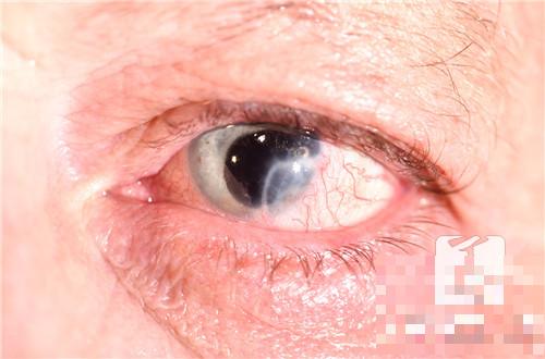 眼睛疼有异物感是什么病？