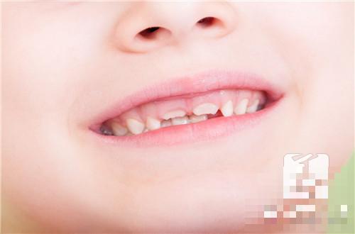 孩子牙齿上有黑斑是怎么回事？