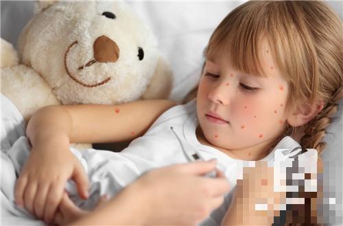 孩子身上起水痘怎么办？