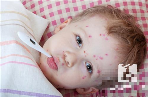 儿童出水痘发烧怎么办？