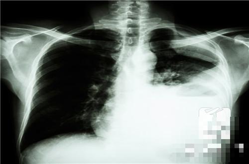 什么是肺叶间裂