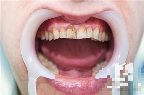 黄牙的危害有哪些？