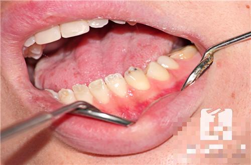 牙龈炎怎么冶？