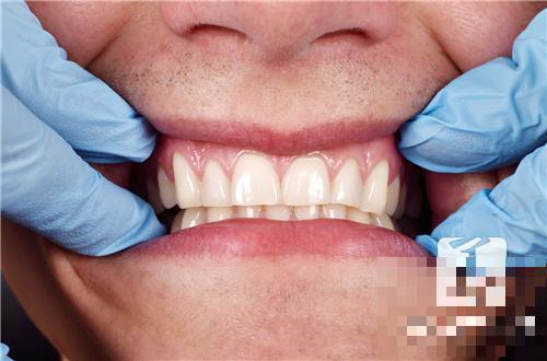 牙龈肿痛吃什么好？专家推荐这7种！