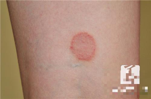 大片红色皮疹是什么病？