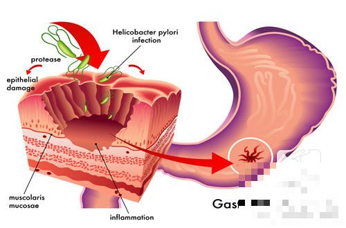 胃息肉活检是胃癌怎么办？