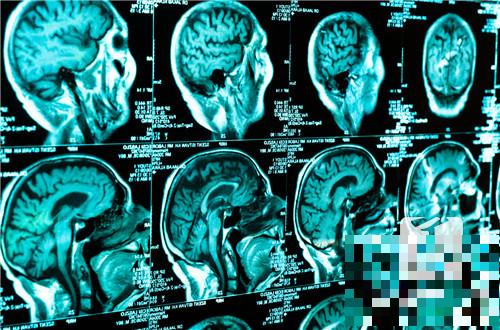 脑部核磁能检查出什么？
