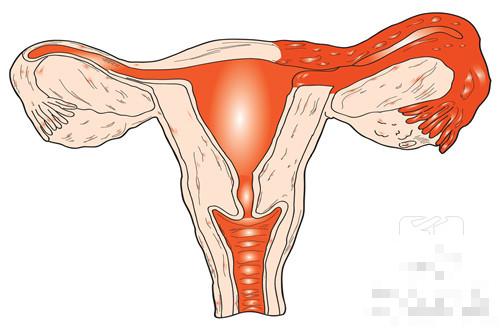 子宫卵巢排毒