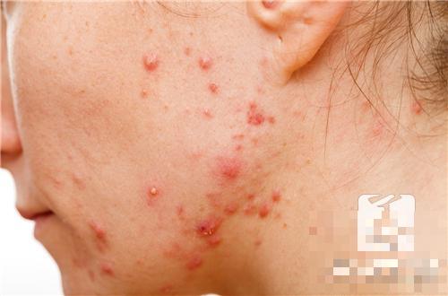 脖子上有一大片红疹子又痒是怎么回事呢？