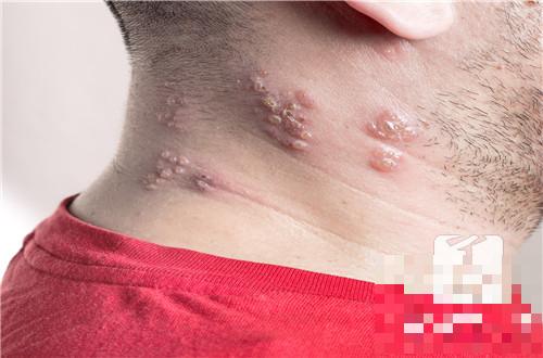 脖子上有一大片红疹子又痒是怎么回事呢？