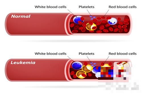 血溶症是什么