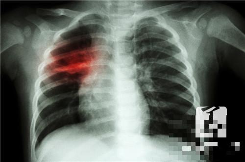 肺结核潜伏期症状表现有哪些