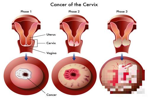 宫颈癌身段有甚么症状