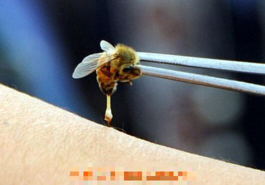 被蜜蜂蛰了怎么处理 被蜜蜂蛰了怎么办